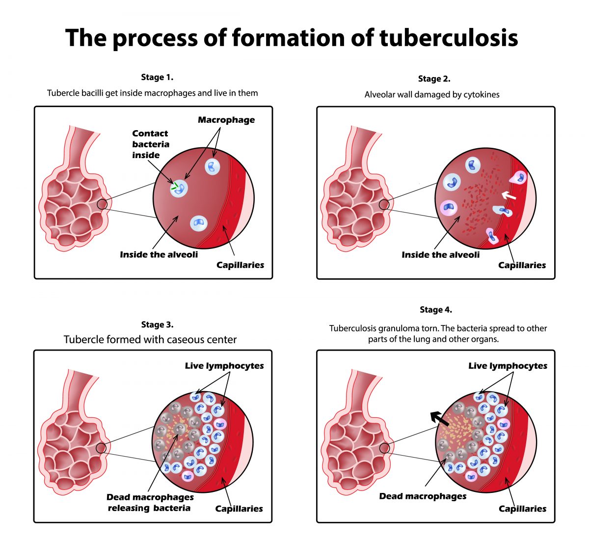 TB Formation